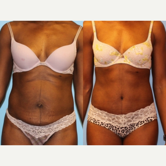 35-44 year old woman treated with Tummy Tuck before 2813319