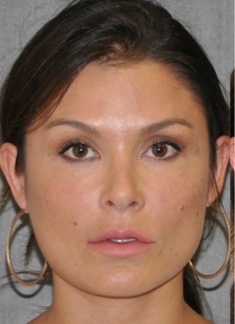 25-34 year old woman treated with Lip Lift before 3004935