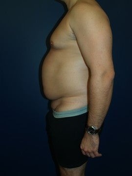 Abdominoplasty and Liposuction 1330541