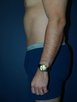 Abdominoplasty and Liposuction 1330541