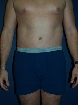 Abdominoplasty and Liposuction after 1330541