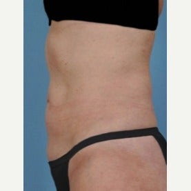 55-64 year old woman treated with CoolSculpting after 2155008
