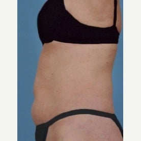 55-64 year old woman treated with CoolSculpting before 2155008