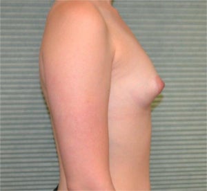 22 year old female breast augmentation 1342391