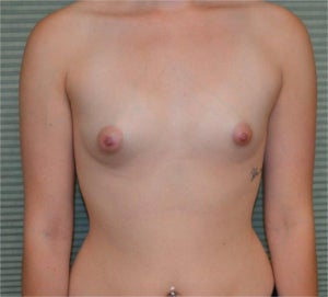 22 year old female breast augmentation before 1342391