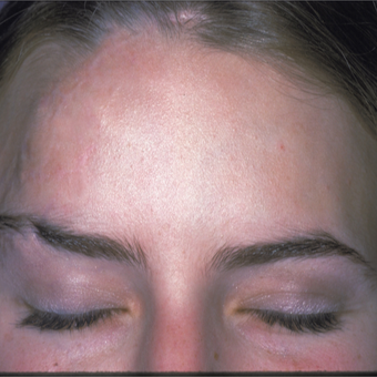 This woman had significant forehead scaring. She underwent scar revision and laser skin resurfacing after 3841019