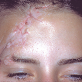 This woman had significant forehead scaring. She underwent scar revision and laser skin resurfacing before 3841019