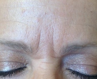 52 year old female treated with Belotero and Botox for lines between her eyes before 1417934