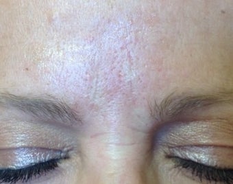 52 year old female treated with Belotero and Botox for lines between her eyes after 1417934