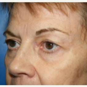 65-74 year old woman treated with Eyelid Surgery 1709759
