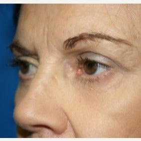 65-74 year old woman treated with Eyelid Surgery 1709759