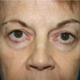 65-74 year old woman treated with Eyelid Surgery before 1709759