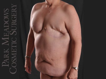removal of failed, painful implant, bilateral DIEP Flap, fat grafting, nipple reconstruction, areola pigmentation 1083667