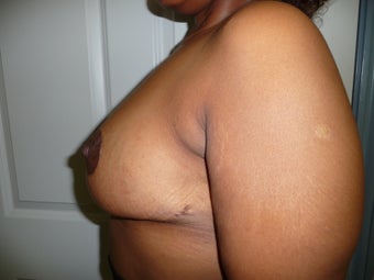 'Ultimate Breast Lift' with no implants 374317