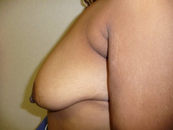 'Ultimate Breast Lift' with no implants 374317