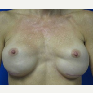 Breast Augmentation before 3054868
