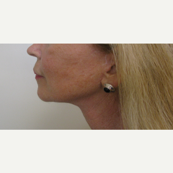 55-64 year old woman treated with Neck Lift after 3383893