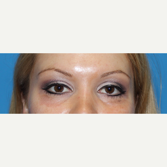25-34 year old woman treated with Juvederm before 3332823