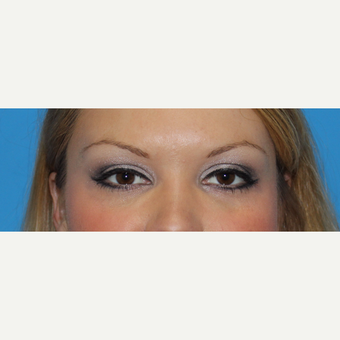 25-34 year old woman treated with Juvederm after 3332823