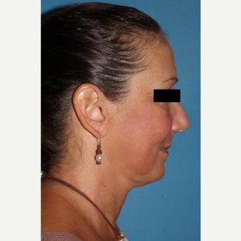 45-54 year old woman treated with Neck Lift after 2089855