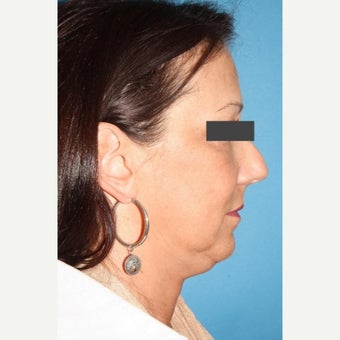 45-54 year old woman treated with Neck Lift before 2089855