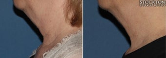 55-64 year old woman treated with Inmode Fractora Forma before 2093848