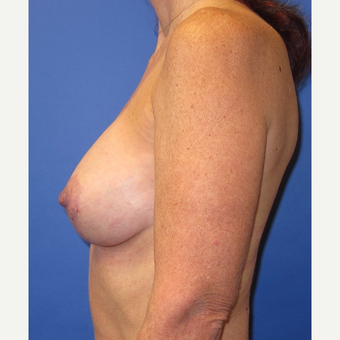 45-54 year old woman treated with Breast Lift with Implants (339cc) after 3760009