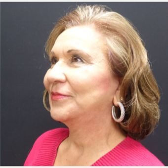 65-74 year old woman treated with Facelift after 3244852