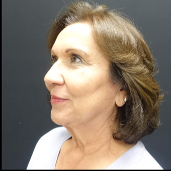 65-74 year old woman treated with Facelift before 3244852
