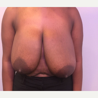 25-34 year old woman treated with Breast Reduction before 3749876