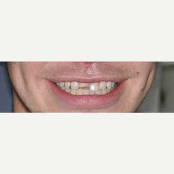 25-34 year old man treated with Dental Crown before 3161951
