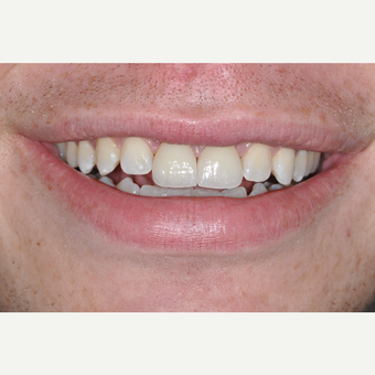 25-34 year old man treated with Dental Crown after 3161951