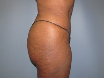 Abdominoplasty (Tummy Tuck) on 56-year-old 951014