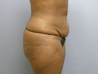 Abdominoplasty (Tummy Tuck) on 56-year-old 951014