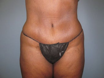 Abdominoplasty (Tummy Tuck) on 56-year-old after 951014