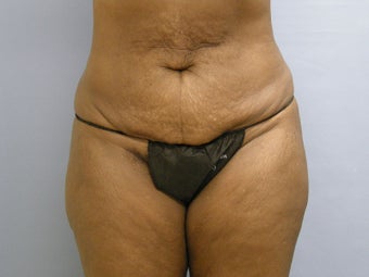 Abdominoplasty (Tummy Tuck) on 56-year-old before 951014