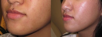 Mole removal using plastic surgery techniques before 718232