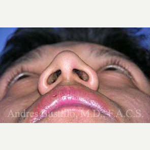 29 year old man treated with Rhinoplasty before 3460975