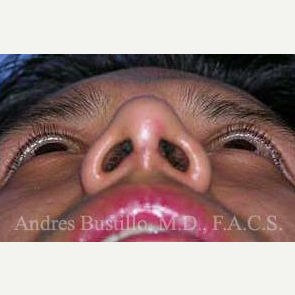 29 year old man treated with Rhinoplasty after 3460975