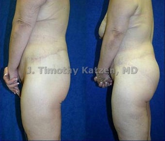 before and after photo silicone buttock implant and lift after RNY gastric bypass after massive weight loss after 360bodylift before 644275