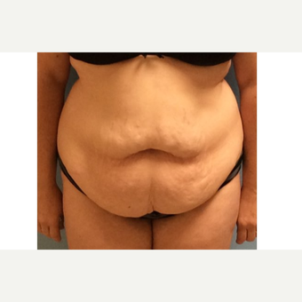 35-44 year old woman treated with Tummy Tuck before 3726078