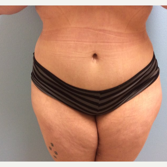 35-44 year old woman treated with Tummy Tuck after 3726078