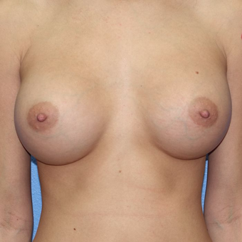 25-34 year old woman treated with Breast Augmentation after 3320772