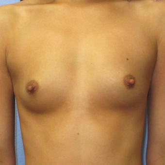 25-34 year old woman treated with Breast Augmentation before 3320772