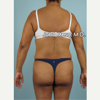 45-54 year old woman treated with Brazilian Butt Lift before 3777641