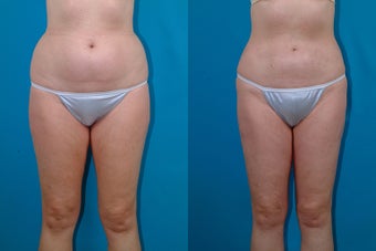 54-year-old woman treated with Liposuction. before 3287590