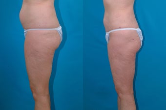 54-year-old woman treated with Liposuction. after 3287590