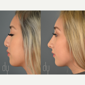 18-24 year old woman treated with Asian Rhinoplasty before 3129815