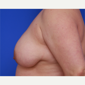 34- year old woman treated with Liposuction to her Breasts before 3583815
