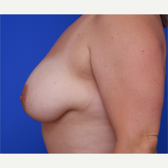 34- year old woman treated with Liposuction to her Breasts after 3583815
